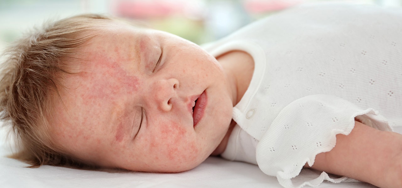 baby with allergic rash on face